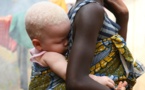 Afrique : les albinos, ou la malédiction dans la peau